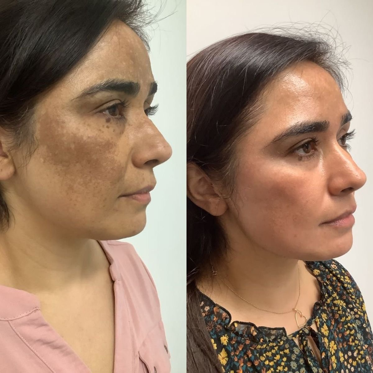 Pigment Therapy