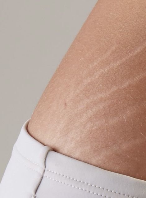 Stretch Marks