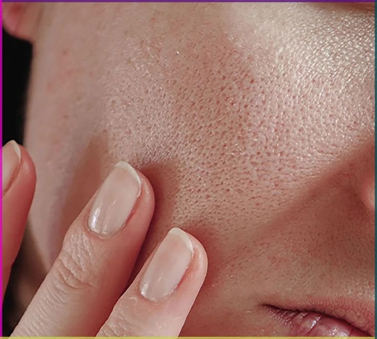 Open Pores