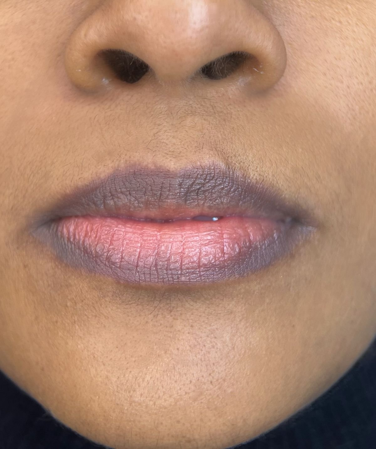 Lip Pigmentation