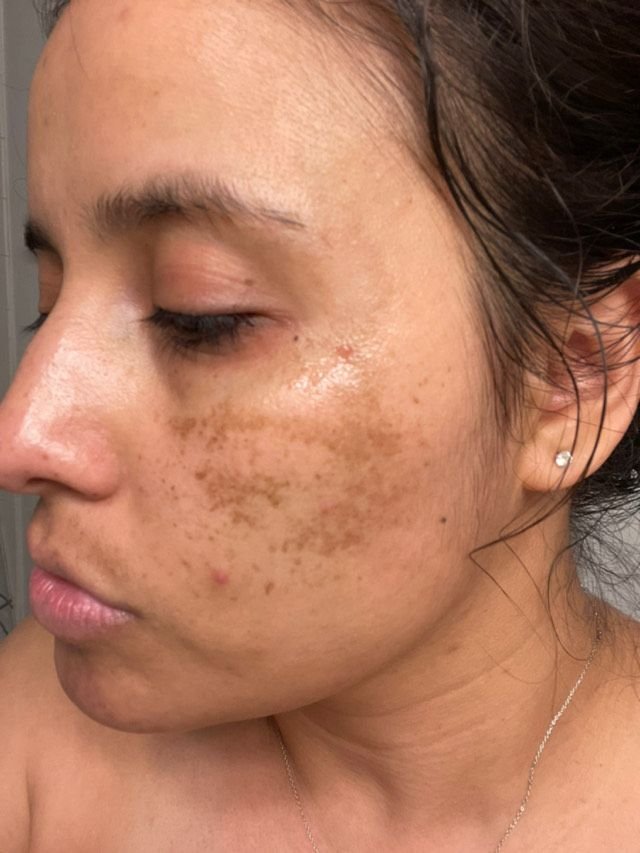 Pigmentation