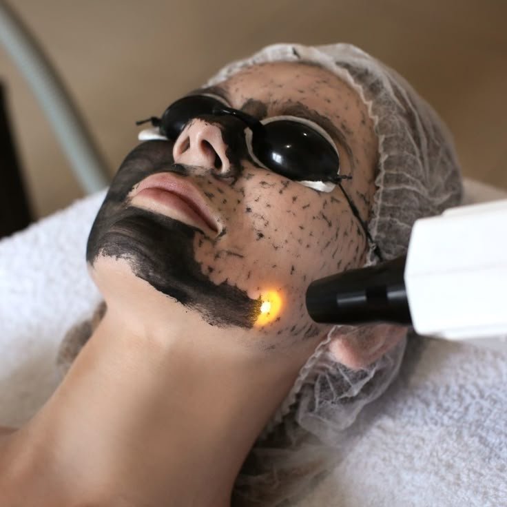 Carbon Peel
