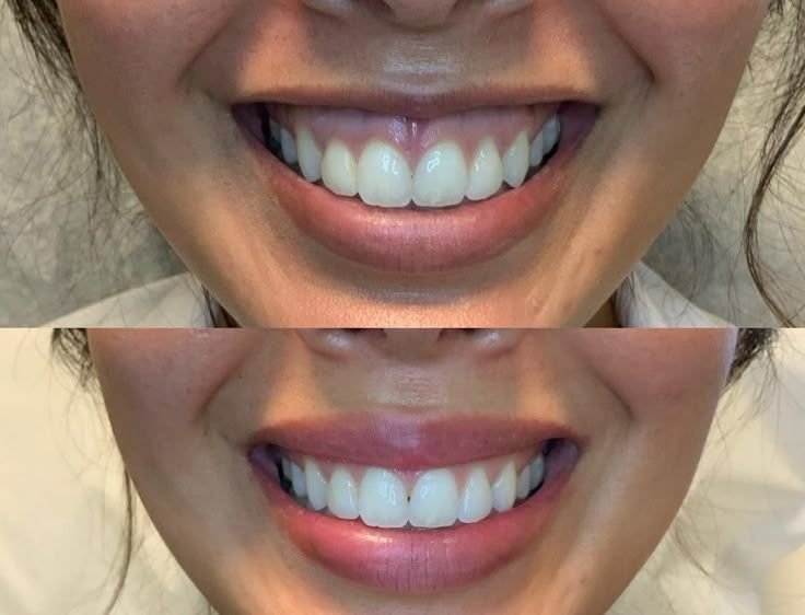 Smile Makeover