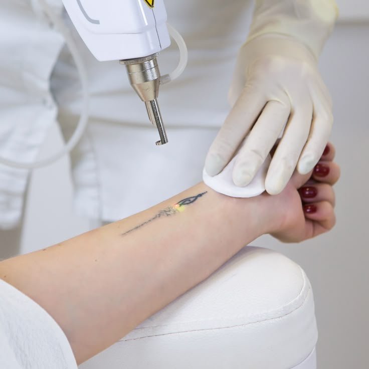 Tattoo Removal
