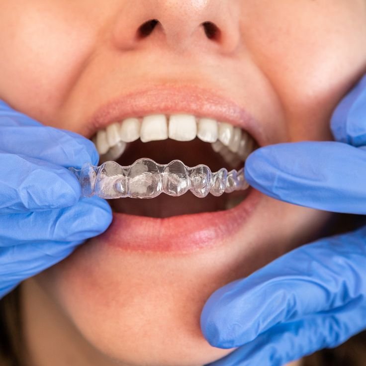 Aligners
