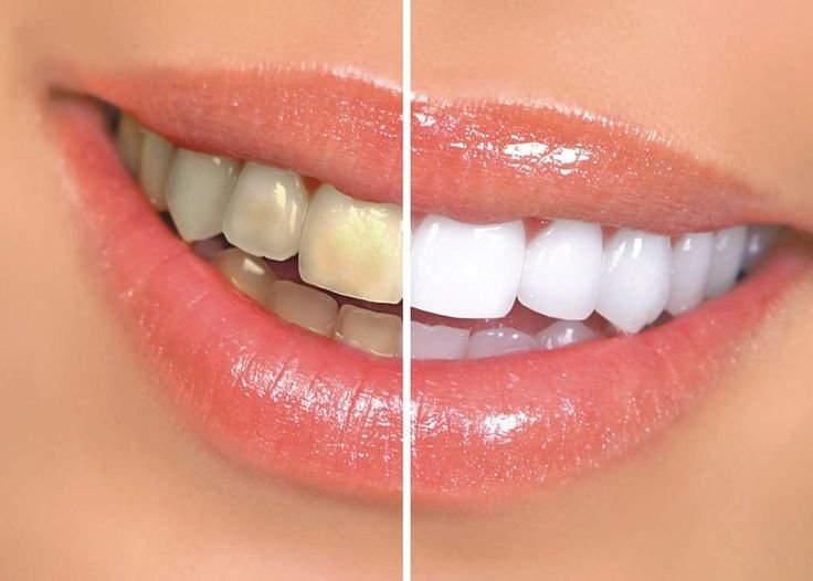 Yellow Teeth