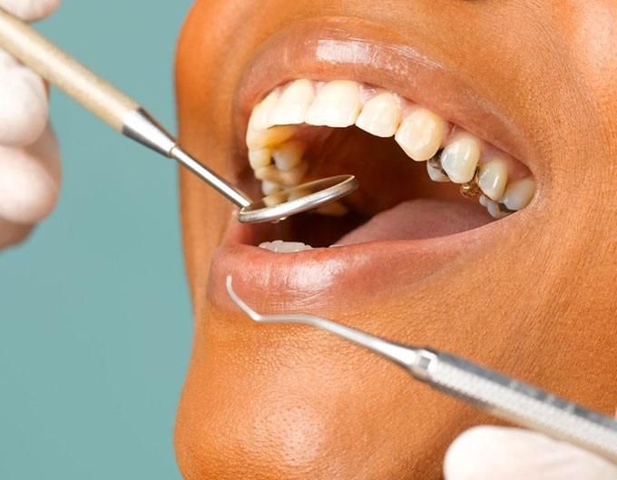 Cavities