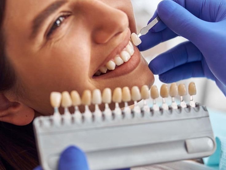 Veneers