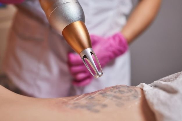 Laser Tattoo Removal