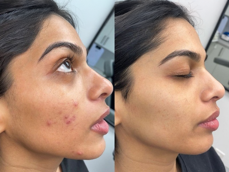 Skin Resurfacing